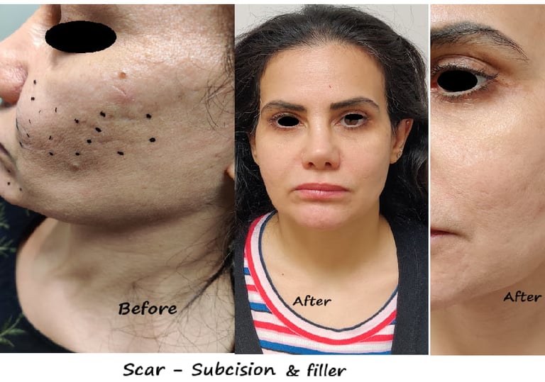 Before and after photos scar treatment with subcision + filler – smoother skin, reduced acne scars.