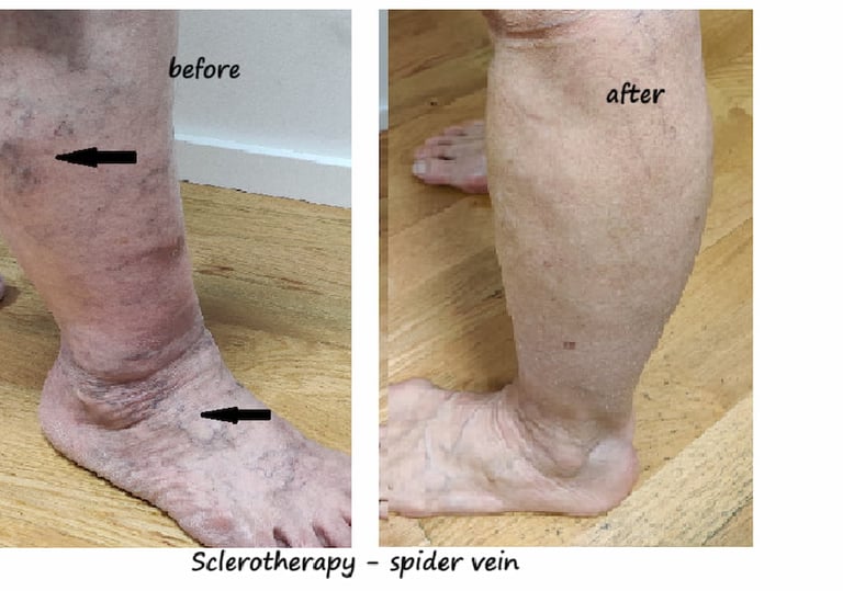 Before & after Spider vein treatment Delhi – veins reduced after sclerotherapy session.