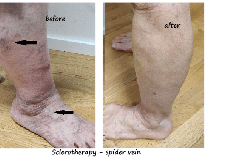 Legs with spider veins before and 6 weeks after sclerotherapy – clear reduction of spider veins.