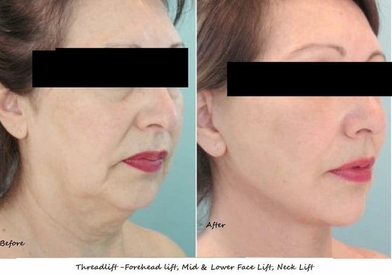 Non-surgical thread lift with fillers and fat reduction, results on 50-year-old woman.
