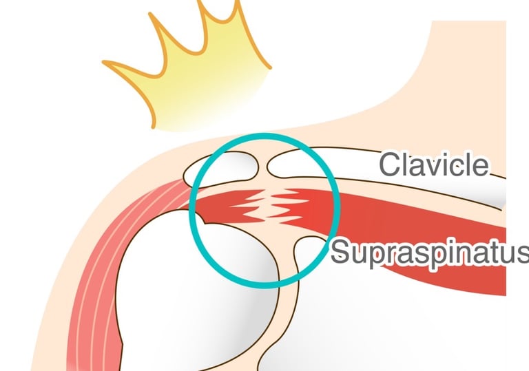 anatomic image of a torn rotator cuff muscle highlighted to indicate pain