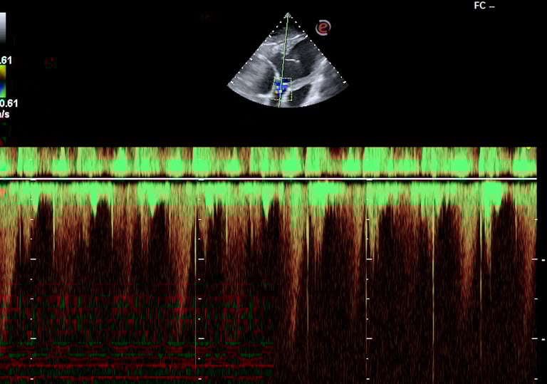 Ecocardiografía Doppler con señal espectral, evaluación de flujo cardiaco