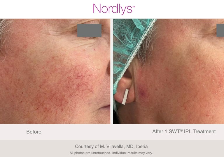 improved skin tone and radiance after professional skin rejuvenation in Hamilton clinic