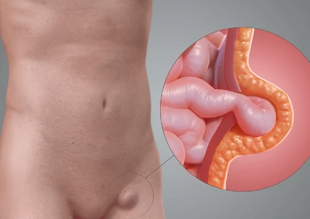 Imagem ilustrativa Hérnia Femoral