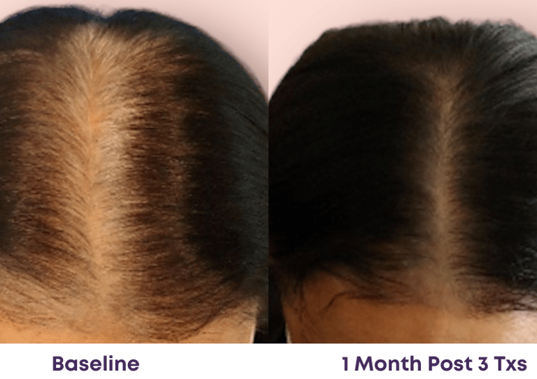 1 month after 3 treatments, the part is narrower and the hair is thicker and fuller