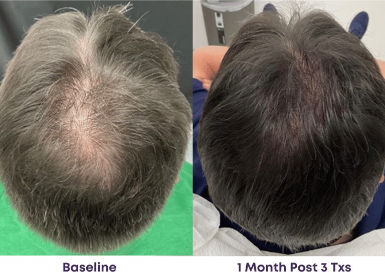 less bald spots after 3 treatments, fuller thicker hair