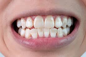 a image showing white spots on teeth of smiling man mouth