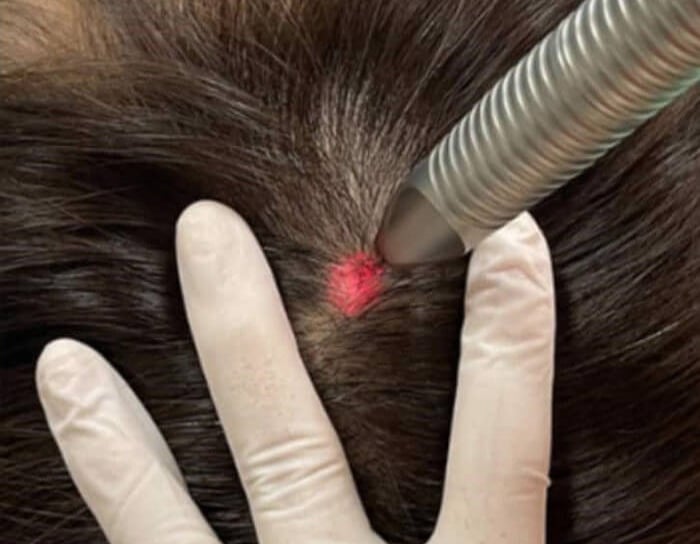 cabinet perma medical : laser