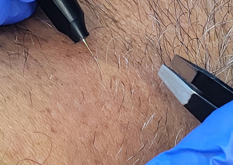 Hair removal electrolysis Edmonton at Ariana esthetic clinic 