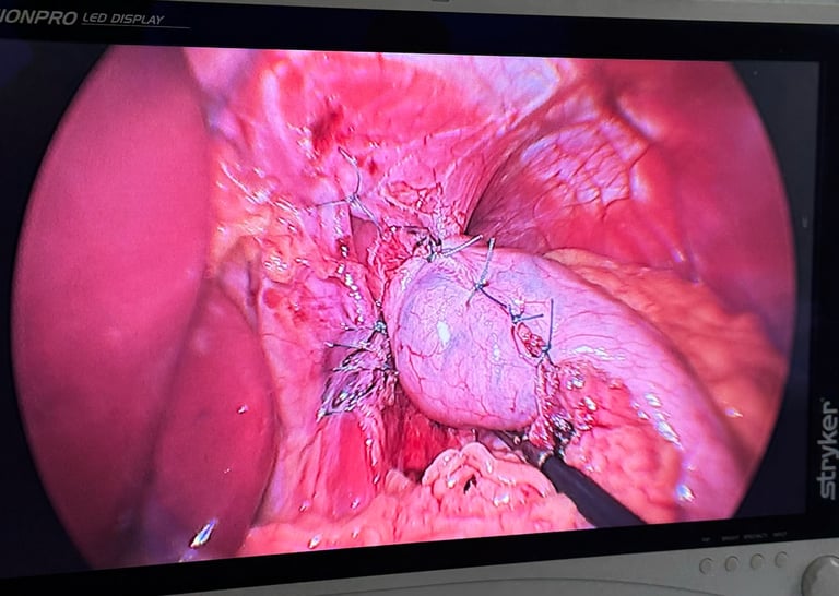 fotografia que mostra cirurgia de refluxo
