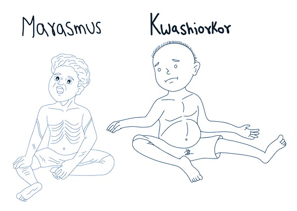 Marasmus