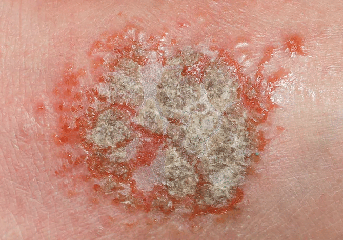 eczema meaning in urdu