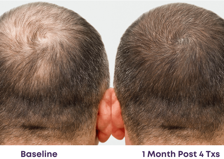 noticeable thicker and fuller hair with less bald spots after 4 treatments