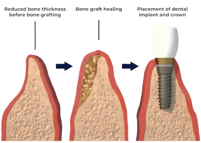 bone graft