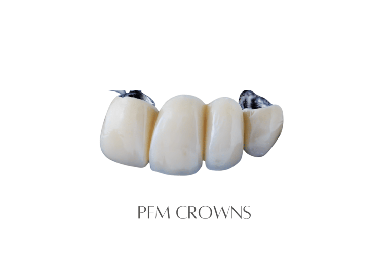 PFM Crowns