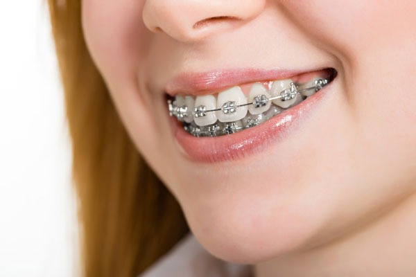 braces orthodontic treatment to correct bite and smile beautifully