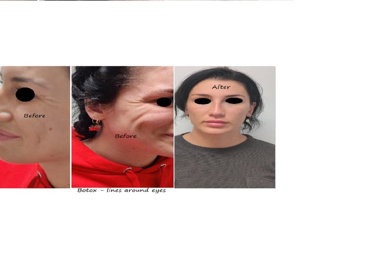 Före- och efterbilder av botox runt ögonen – slätare hud och yngre utseende.