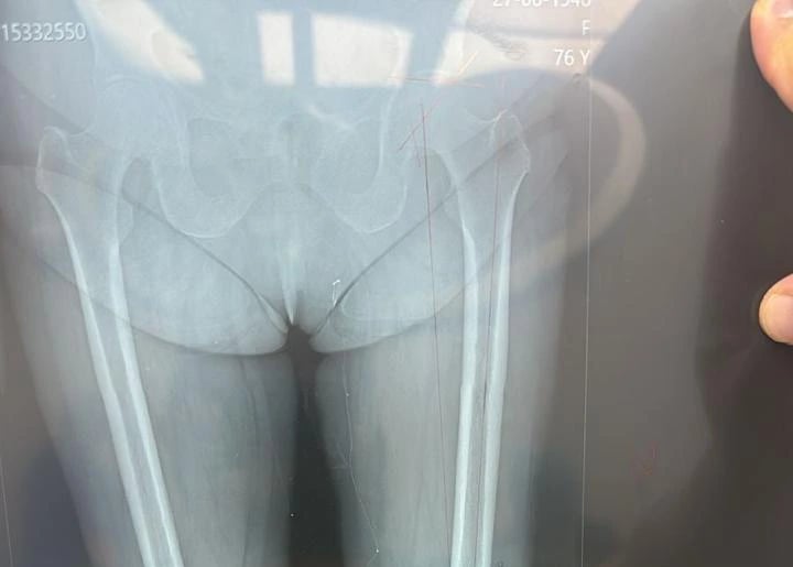 radiografía de cadera