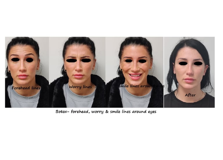 Före- & efterbild botox övre ansikte – fräschare, mer tilltalande och piggare utseende.