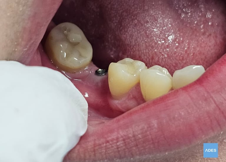 Servicio de implantes en Badajoz
