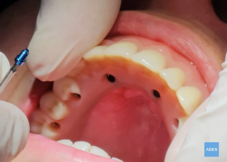 protesis sobre implantes