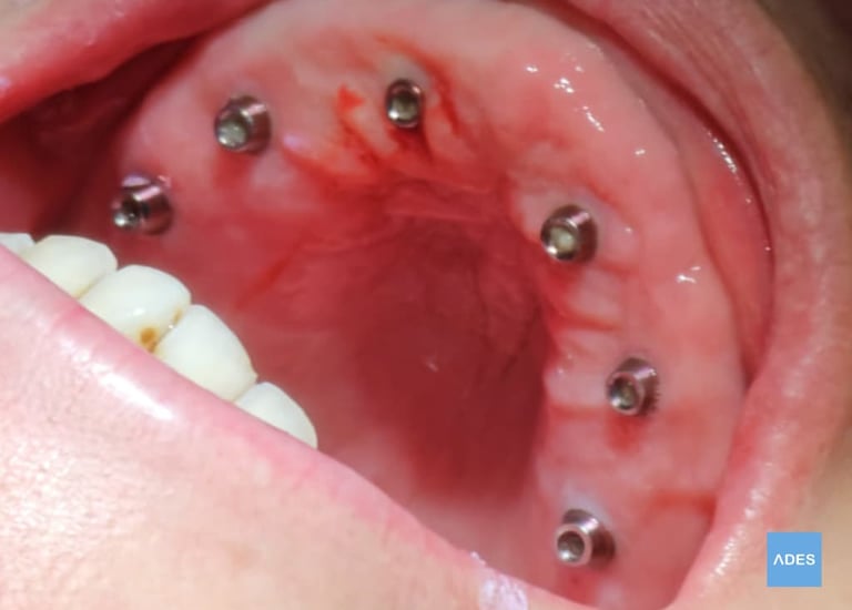 implantes colocados