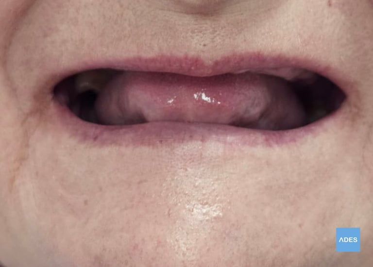 Paciente recibiendo implantes dentales en Badajoz