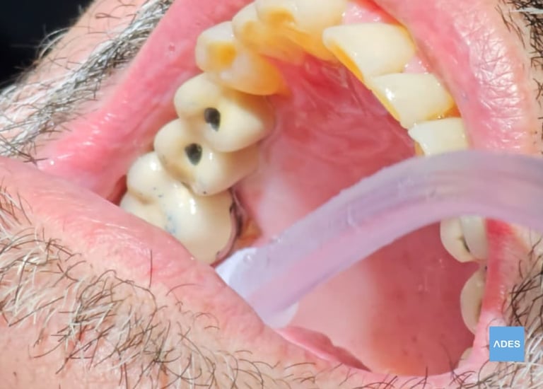 puente sobre implantes