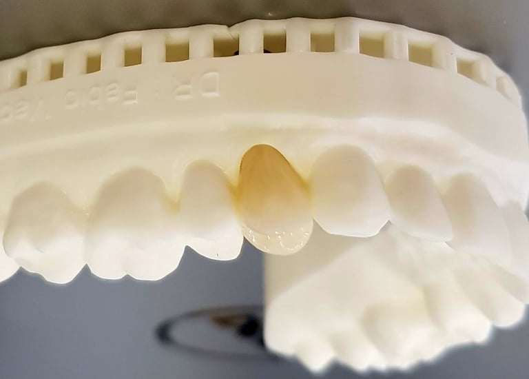 Moldura de dentes ilustrando implantes dentários realizados por dentista na Lapa PR.