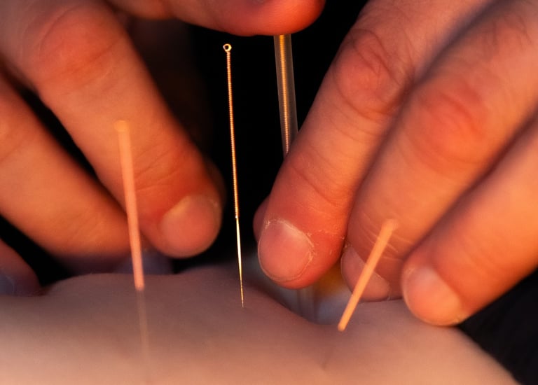dry needling