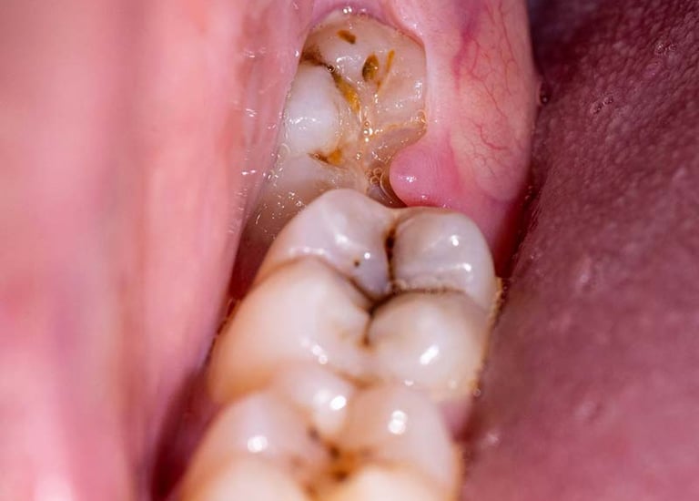 an image showingimpacted wisdom third molar
