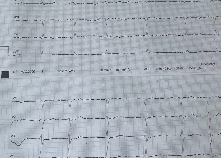EKG