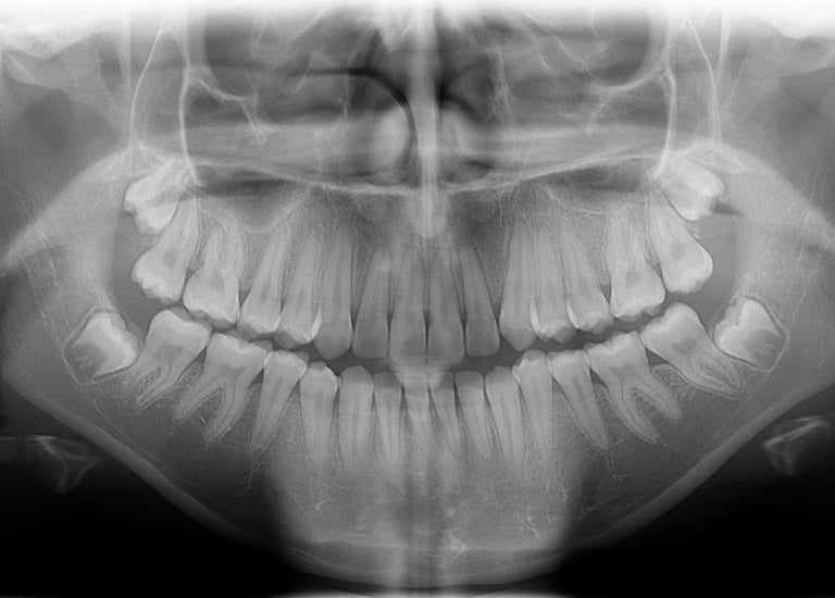 extraccion de cordales dolor cordal