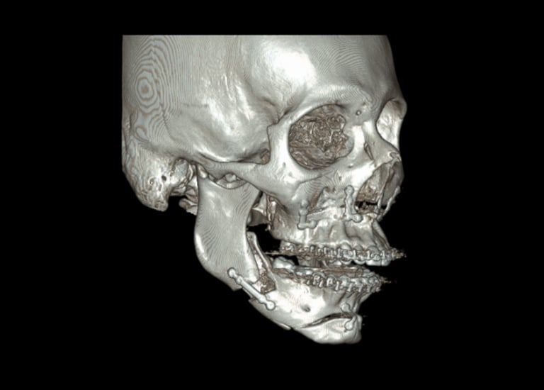 cirugia mandibula grande mandibula pequeña