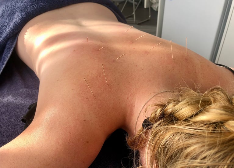 A woman is lying on her front with acupuncture needles in her shoulders and back