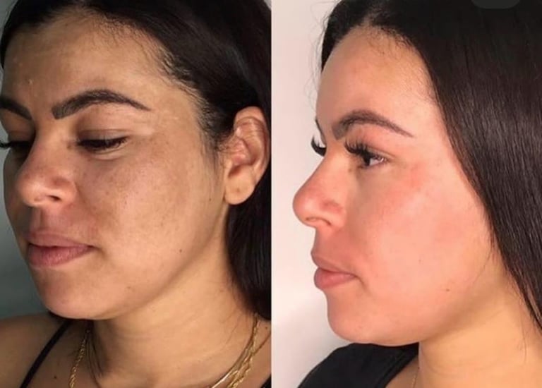 peeling facial renovação da pele - clínica estética Tatuapé