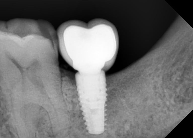 Best dental implants at Speciality Dental Clinic Malad Mumbai