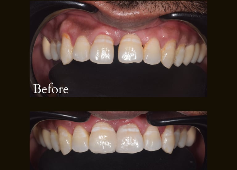 Teeth gap closure with Invisalign invisible braces and aligners done by best cosmetic dentist near Malad West in Mumbai
