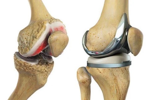 best knee replacement surgeon in jayanagar