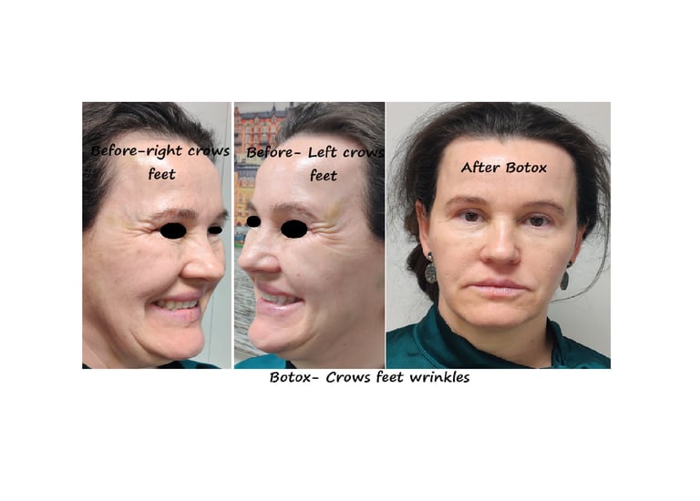 Före- och efterbilder av botox runt ögonen – slätare hud och yngre utseende.