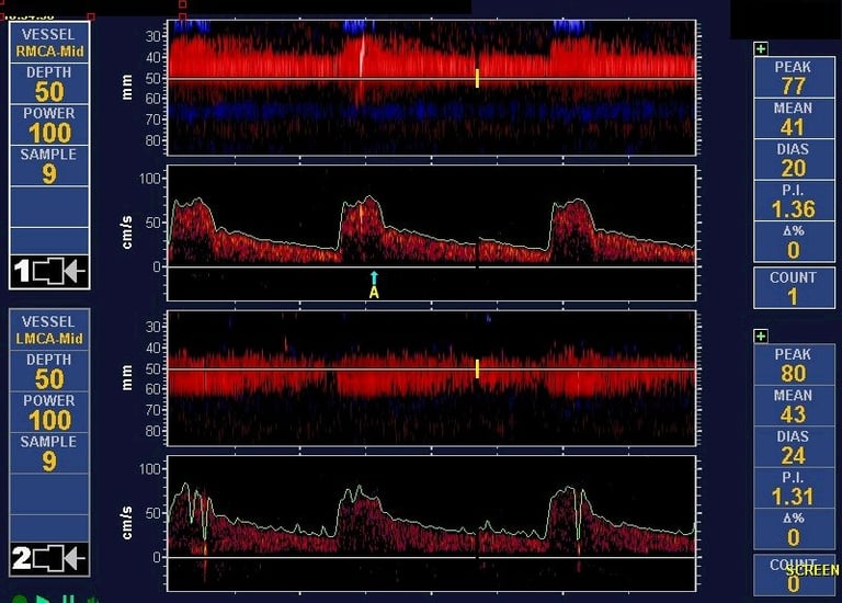 Transcranial Doppler TCD microembolus MES