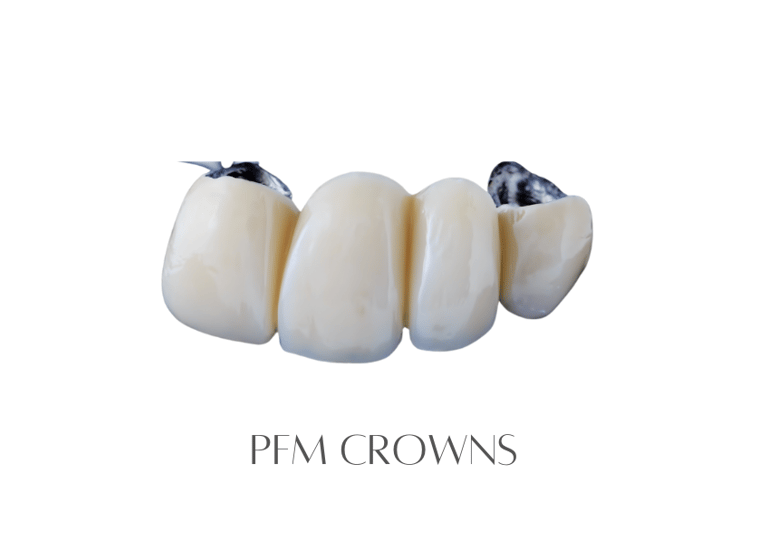 PFM Crowns
