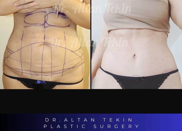 body lift before after photos, Antalya