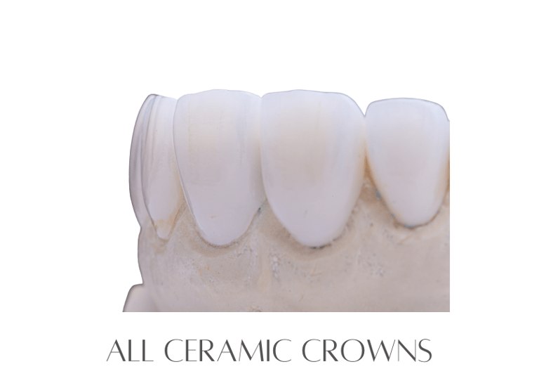 All Ceramic Crowns