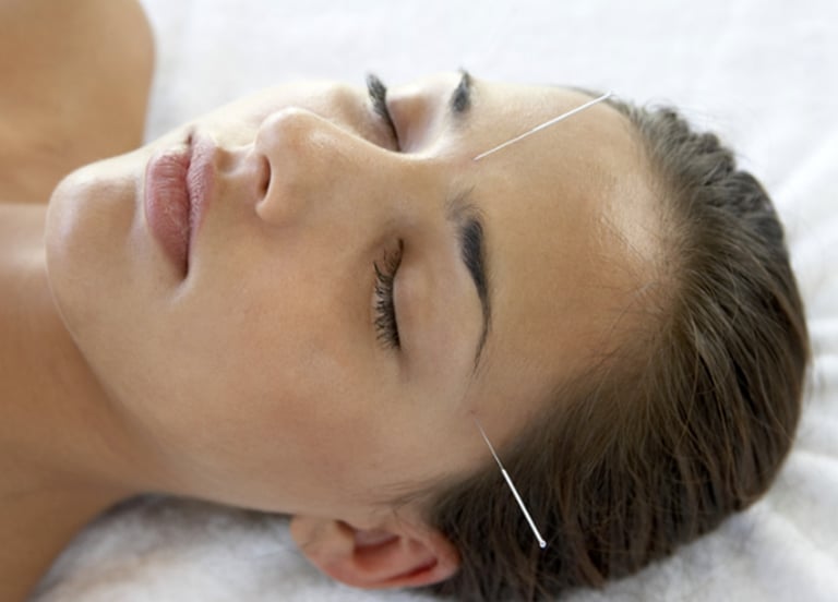 Close‑up of a person receiving acupuncture with fine needles placed on the forehead and temple
