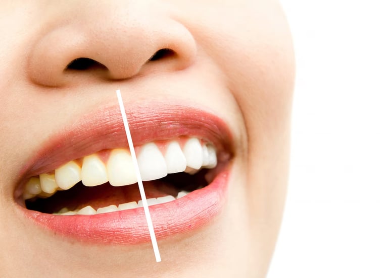 teeth whitening before and after
