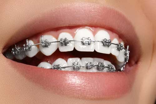 teeth with braces
