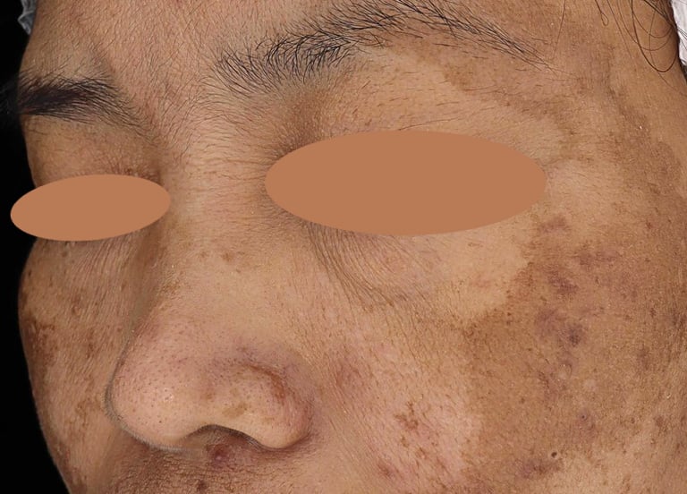 melasma hyperpigmentation singapore