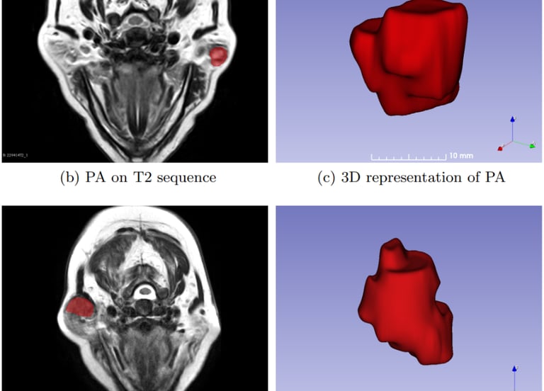 Example images of Pleomorphic Adenoma and Warthin’s Tumor