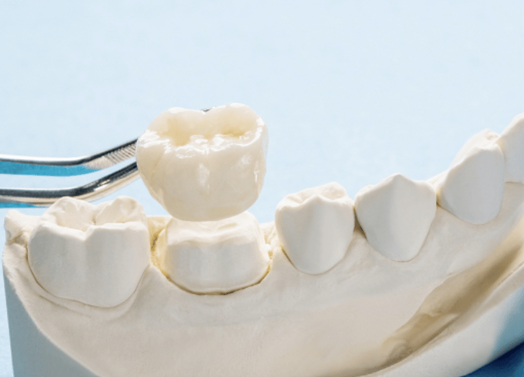 model of a dental crown